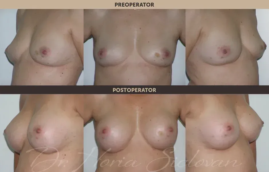 Cazul 40: Augmentare mamara subfasciala, implanturi anatomice Mentor® 260 cm³