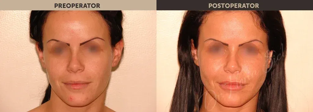 Caz 1: Lipofilling (implant grasime)