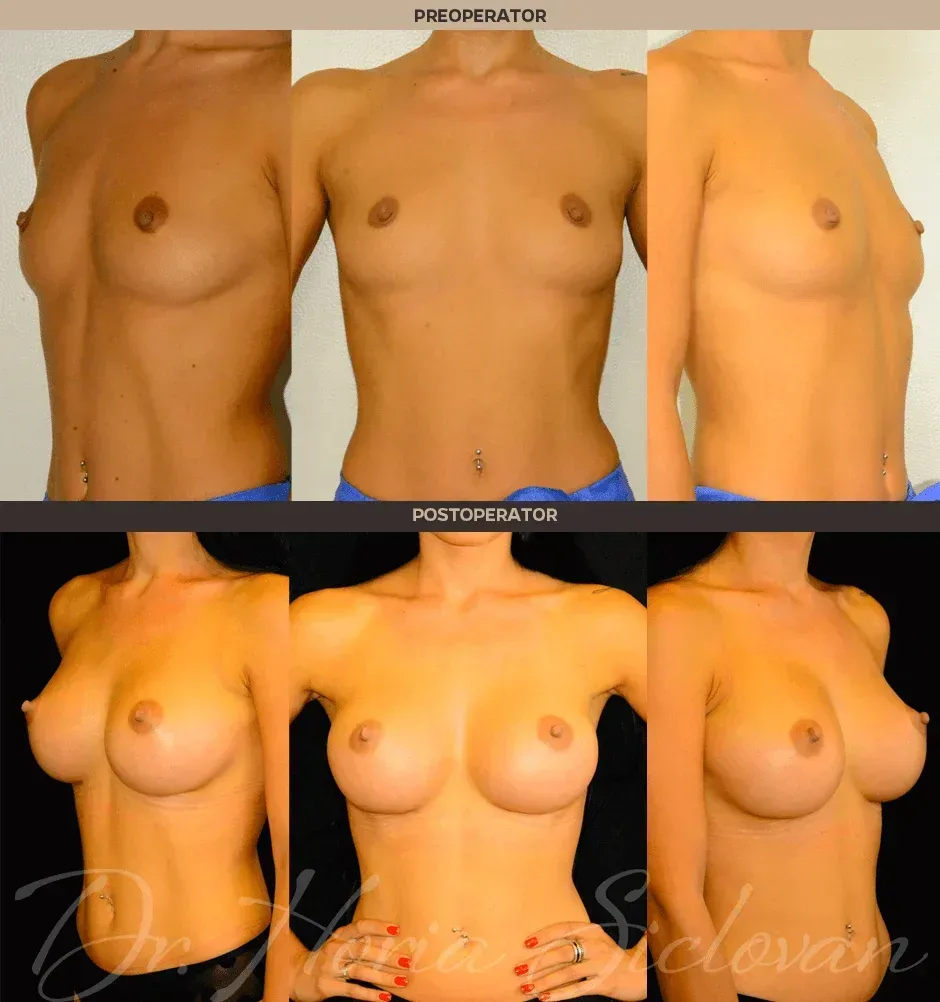 Caz 3: Augmentare mamara (tehnica muscle splitting biplane), implanturi anatomice Mentor® 345 cm³