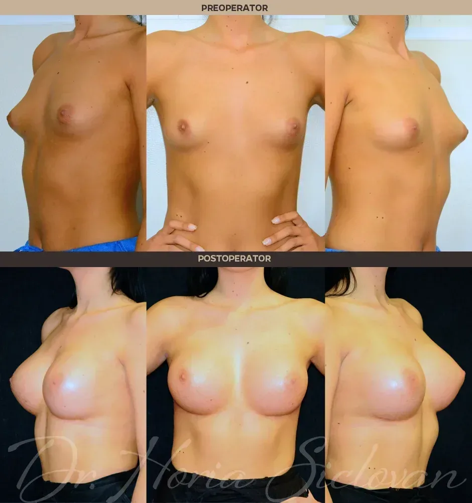 Caz 104: Augmentare mamara subfasciala, implanturi anatomice Mentor® 380 cm³