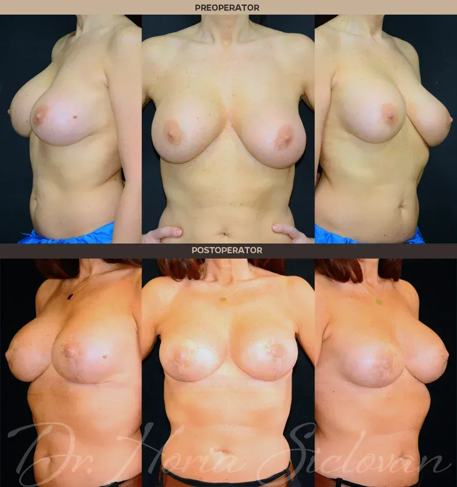 Caz 15: Preoperator: Augmentare mamara (muscle splitting biplane) implanturi anatomice Mentor® 390 cm³ (rezultat 8 ani postoperator) / Postoperator: Mamopexie cu augmentare mamara (muscle splitting biplane), implanturi rotunde Mentor® 340 cm³