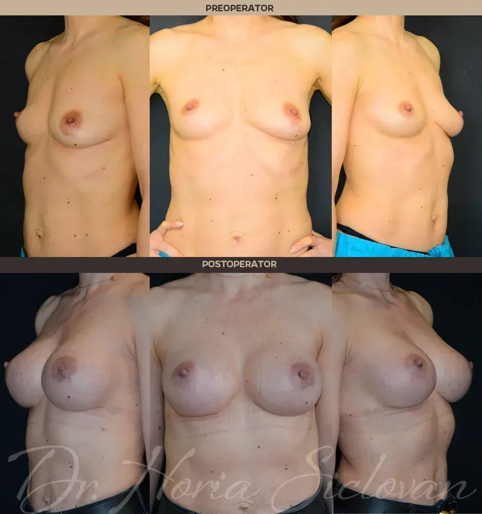 Caz 123 - Augmentare mamara (tehnica muscle splitting biplane) si mamopexie interna, implanturi anatomice Mentor® 380 cm³ si 305 cm³
